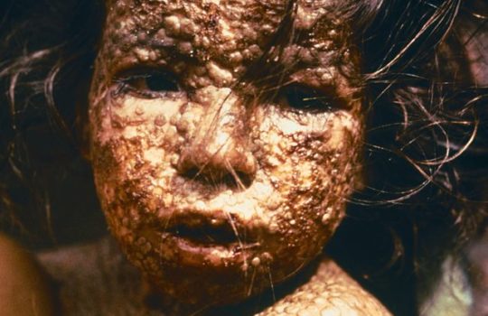 La vaccination antivariolique en cas d’attaque NRBCe