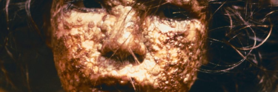 La vaccination antivariolique en cas d’attaque NRBCe